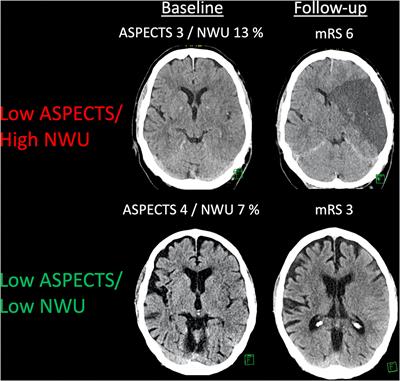 The Benefit of Thrombectomy in Patients With Low ASPECTS Is a Matter of Shades of Gray—What Current Trials May Have Missed